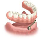 Removable Implant